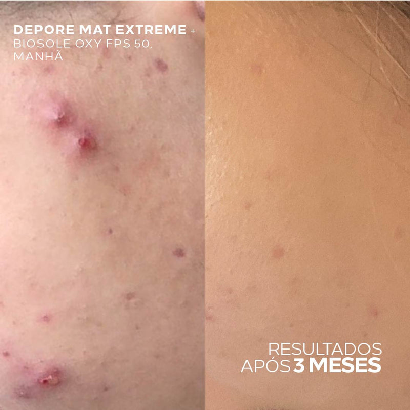 Creme Hidratante Ultra Matificante com Tripla Ação Secativa Para Peles Oleosas – Depore Mat Extreme Anti-Oleosidade 40g