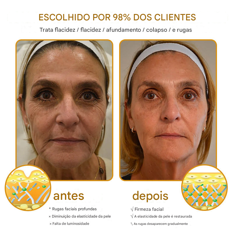 Creme removedor de rugas Botox Bee Venom - 🐝 Promoção relâmpago: só hoje! (Somente HOJE!)🔥