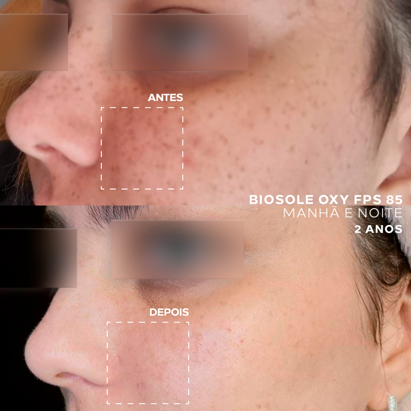 Protetor Solar Facial Clareador para Pele com Melasma - Biosole Oxy FPS 85 - 40ml
